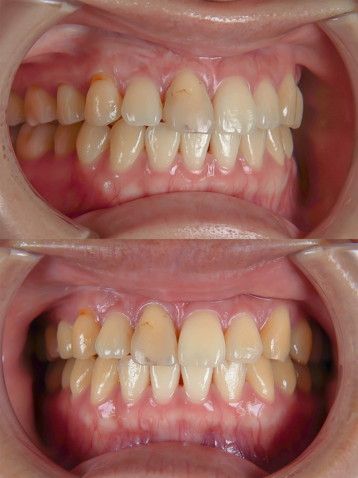 前歯が変色している状態に対してダイレクトボンディングにて対応した症例治療方法01